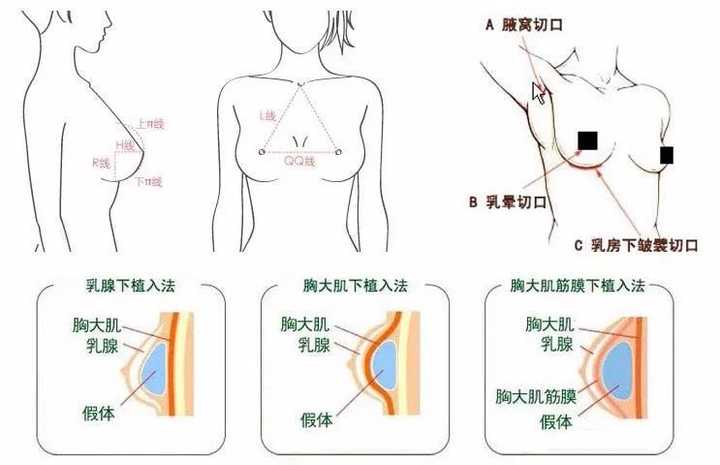 最新隆胸方法揭秘，當(dāng)下最受歡迎的隆胸方式與趨勢(shì)